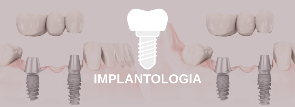 implantologia-image