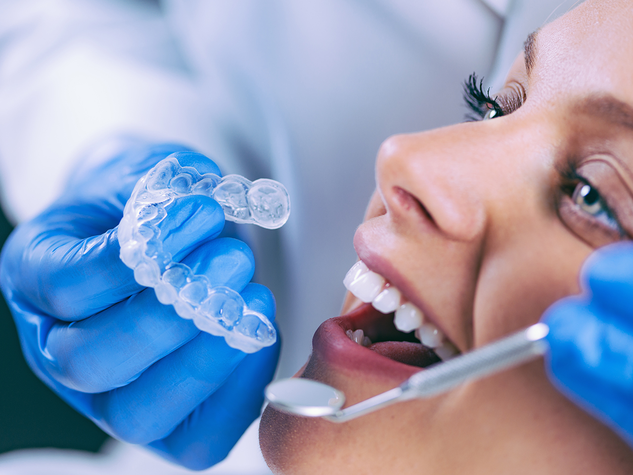 ortodonzia allineatori dentali trasparenti