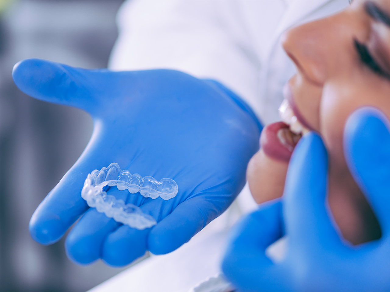 ortodonzia allineatori dentali trasparenti